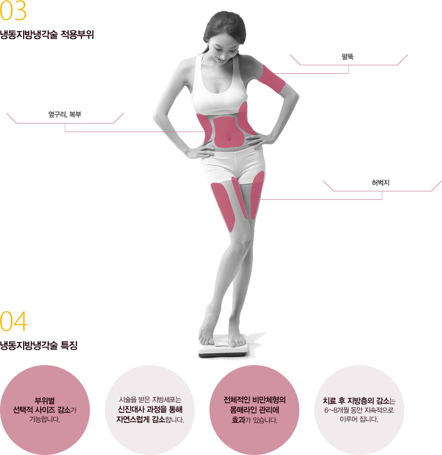 냉동지방냉각술 시술 원리